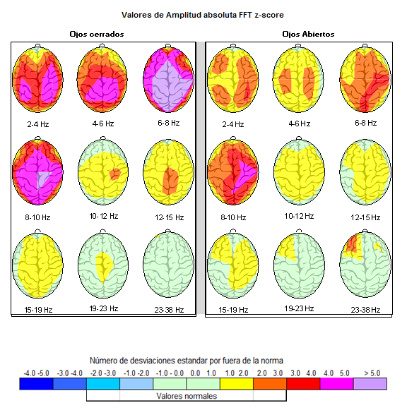 Mapas QEEG de actividad cerebral expresados mediante valores z-score